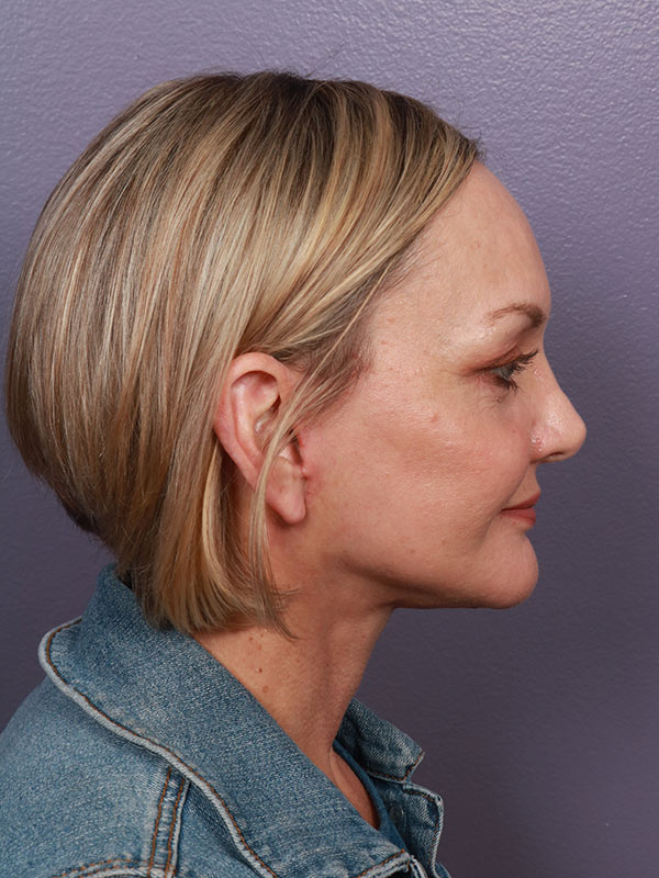 Facelift Before & After Image