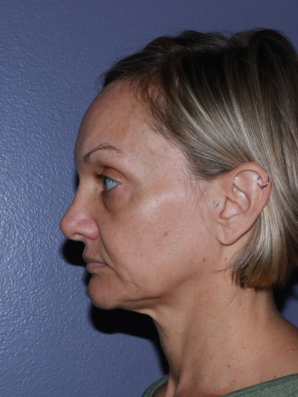 Facelift Before & After Image