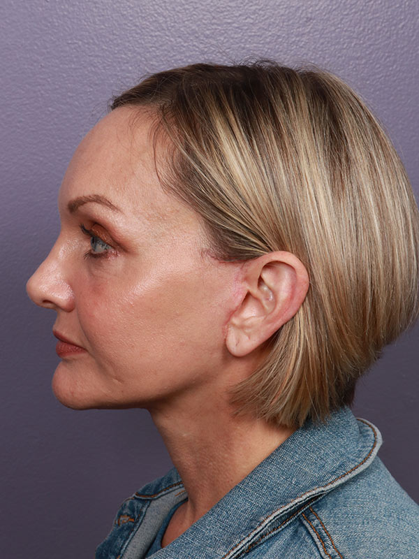 Facelift Before & After Image