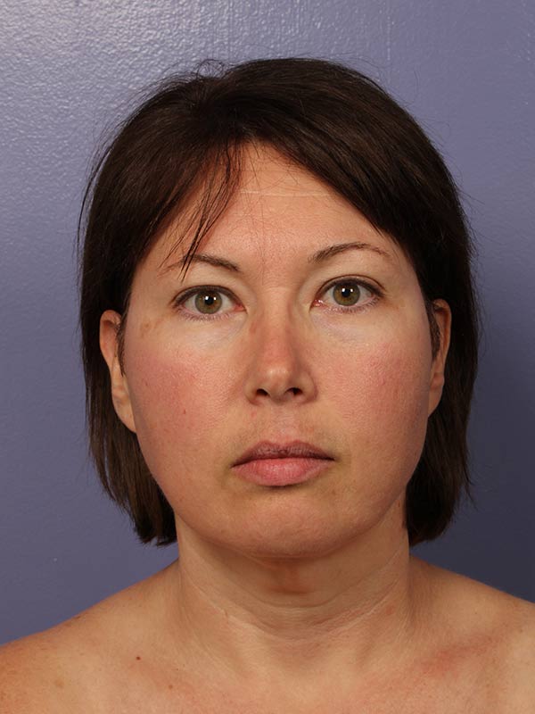 Facelift Before & After Image