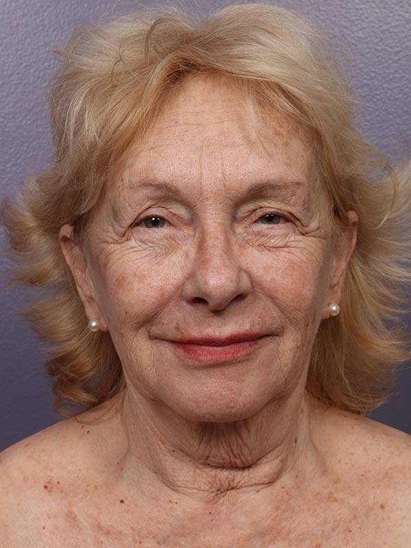 Facelift Before & After Image