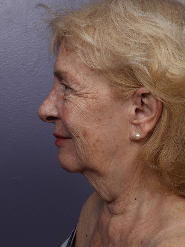 Facelift Before & After Image