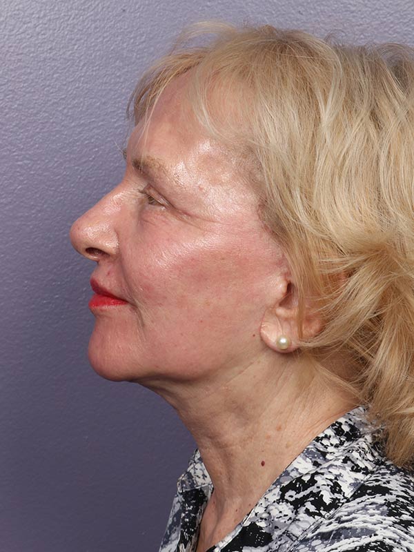 Facelift Before & After Image