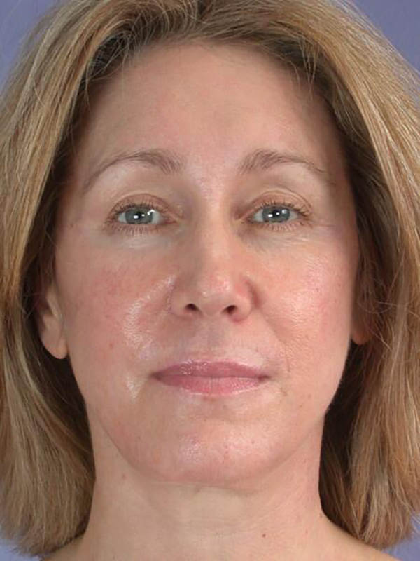 Facelift Before & After Image