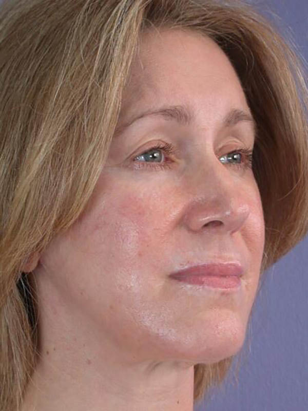 Facelift Before & After Image