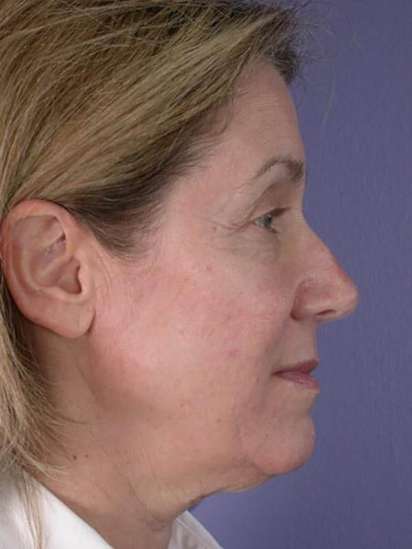 Facelift Before & After Image