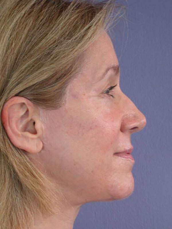 Facelift Before & After Image