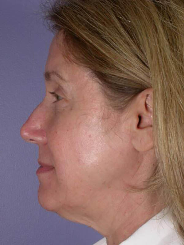 Facelift Before & After Image