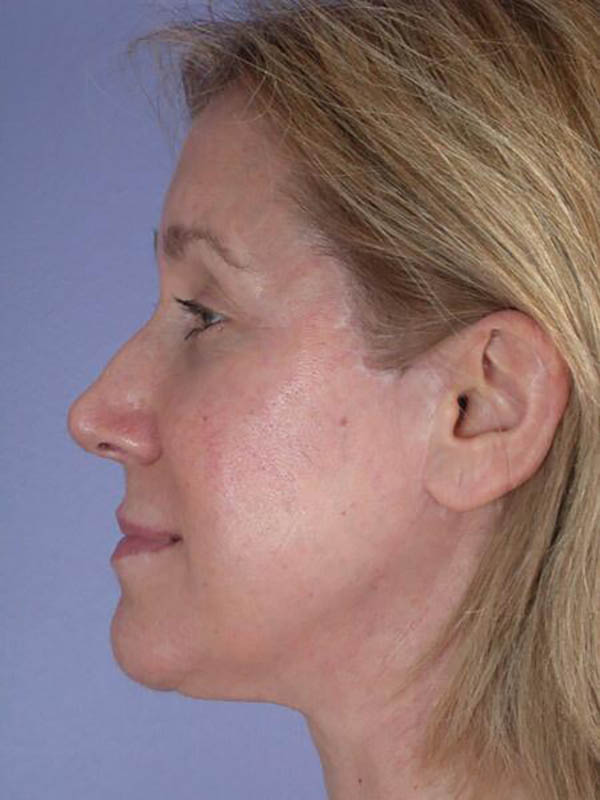 Facelift Before & After Image