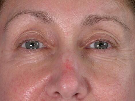 Facelift Before & After Image