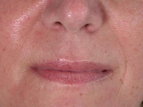 Facelift Before & After Image