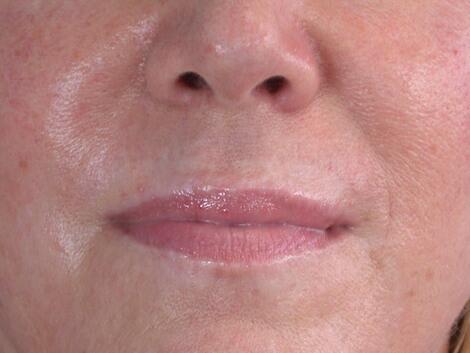 Facelift Before & After Image