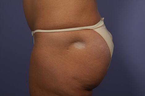 Fat Grafting Before & After Image