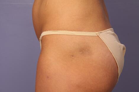 Fat Grafting Before & After Image