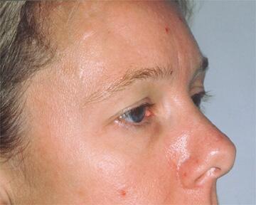 Forehead Lift (Browlift) Before & After Image