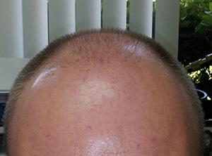 Hair Restoration by NeoGraft® Before & After Image