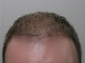 Hair Restoration by NeoGraft® Before & After Image