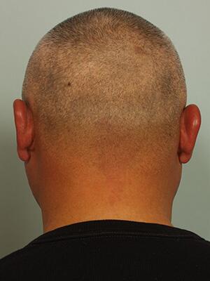 Hair Restoration by NeoGraft® Before & After Image