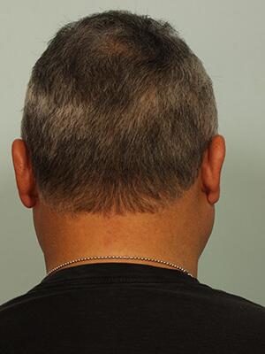 Hair Restoration by NeoGraft® Before & After Image