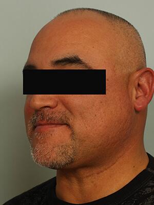 Hair Restoration by NeoGraft® Before & After Image