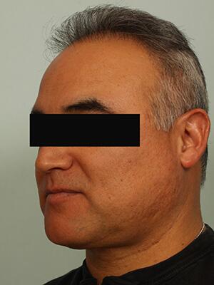 Hair Restoration by NeoGraft® Before & After Image