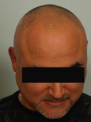 Hair Restoration by NeoGraft® Before & After Image