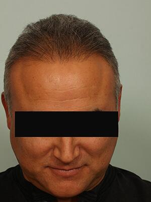 Hair Restoration by NeoGraft® Before & After Image