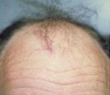 Hair Restoration by NeoGraft® Before & After Image