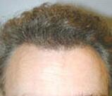 Hair Restoration by NeoGraft® Before & After Image