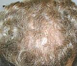 Hair Restoration by NeoGraft® Before & After Image