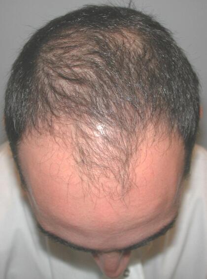 Hair Restoration by NeoGraft® Before & After Image