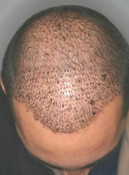 Hair Restoration by NeoGraft® Before & After Image