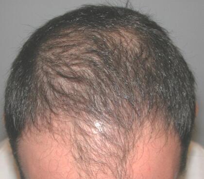 Hair Restoration by NeoGraft® Before & After Image