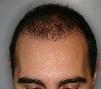 Hair Restoration by NeoGraft® Before & After Image