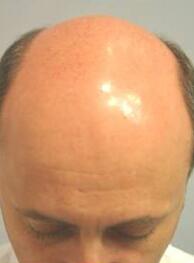 Hair Restoration by NeoGraft® Before & After Image