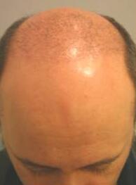 Hair Restoration by NeoGraft® Before & After Image