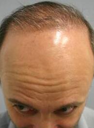 Hair Restoration by NeoGraft® Before & After Image