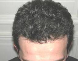 Hair Restoration by NeoGraft® Before & After Image