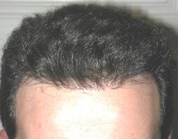 Hair Restoration by NeoGraft® Before & After Image