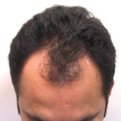 Hair Restoration by NeoGraft® Before & After Image