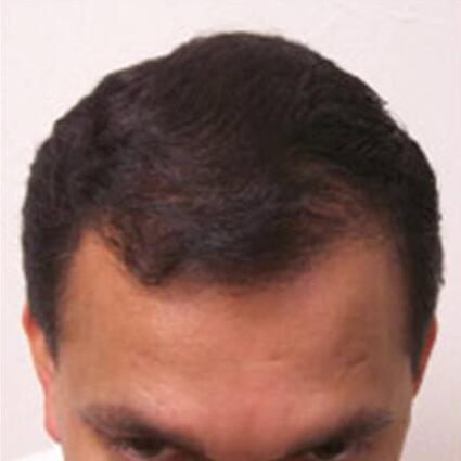 Hair Restoration by NeoGraft® Before & After Image