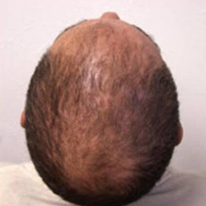 Hair Restoration by NeoGraft® Before & After Image