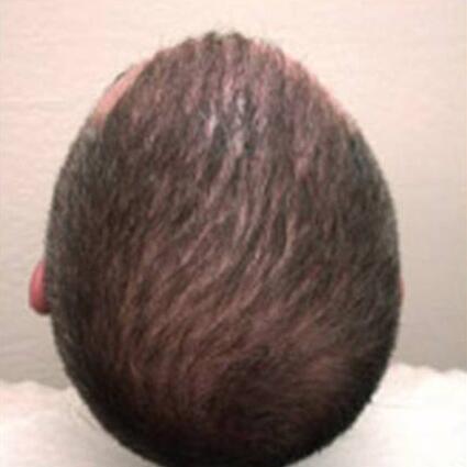 Hair Restoration by NeoGraft® Before & After Image