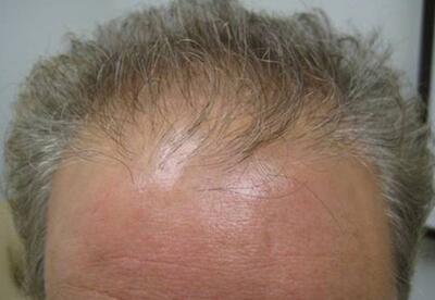 Hair Restoration by NeoGraft® Before & After Image