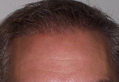 Hair Restoration by NeoGraft® Before & After Image