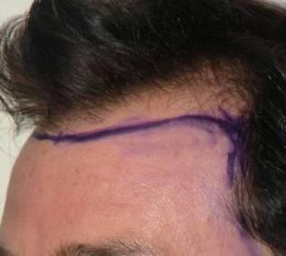 Hair Restoration by NeoGraft® Before & After Image