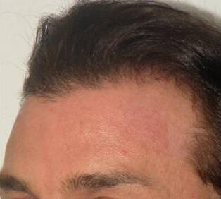 Hair Restoration by NeoGraft® Before & After Image