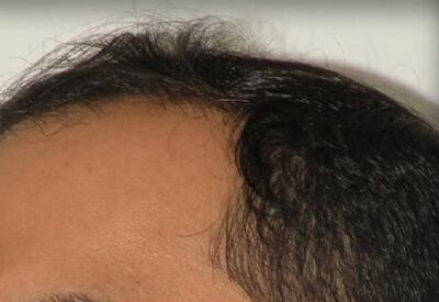 Hair Restoration by NeoGraft® Before & After Image