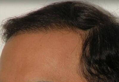 Hair Restoration by NeoGraft® Before & After Image