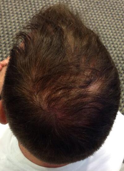 Hair Restoration by NeoGraft® Before & After Image